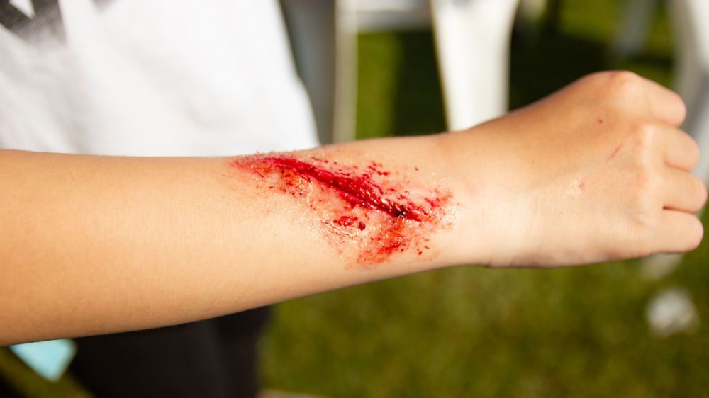 Cuts and wounds