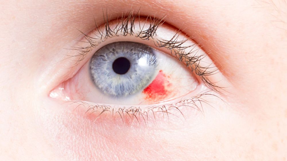 Eye Injury
