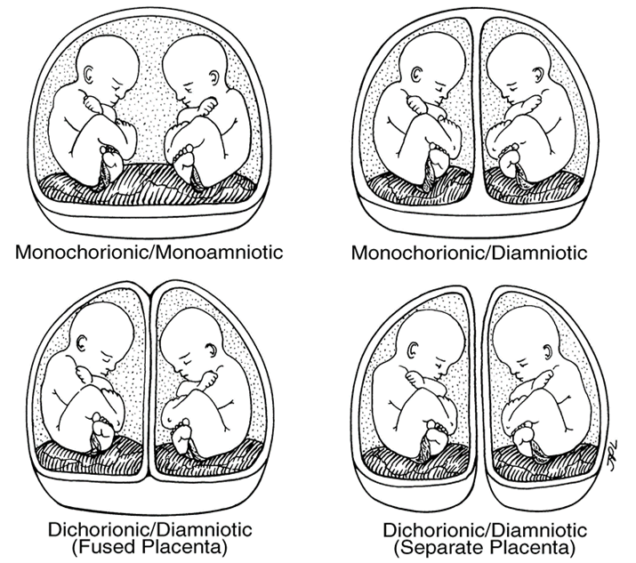 Triplet Pregnancy Diagram