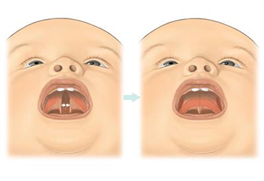 Cleft palate.png