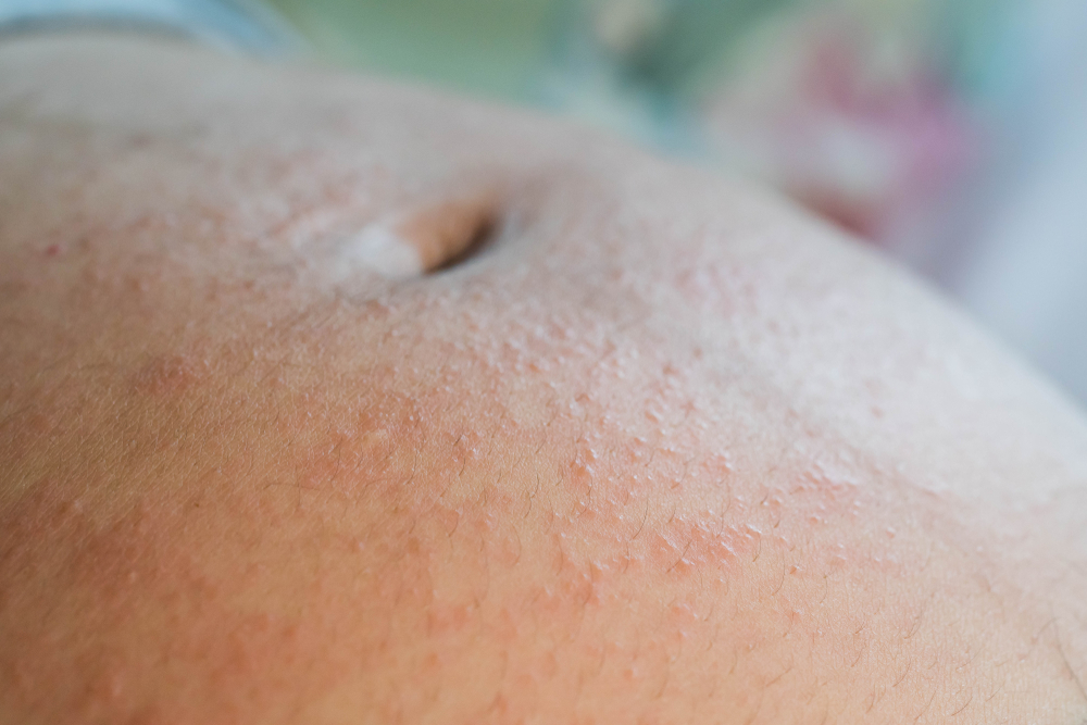 Itching or rash